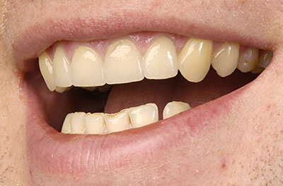 Veneers (Keramikschalen) nachher - Dr. Bettina Arkona Hofheim