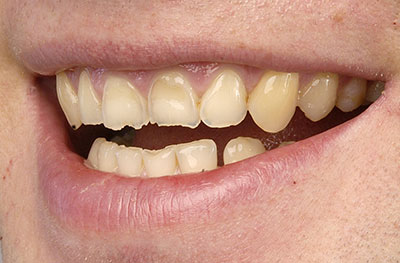 Veneers (Keramikschalen) vorher - Dr. Bettina Arkona Hofheim